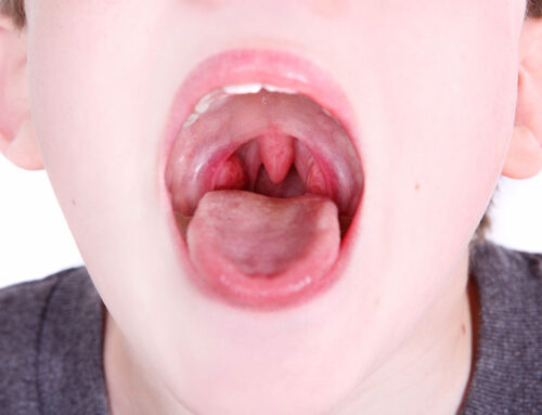 Strep Throat Q&A by Hillary Lewis, MD and James Watkins, MD